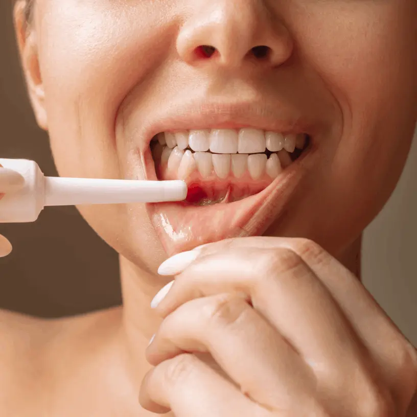 Periodontitis