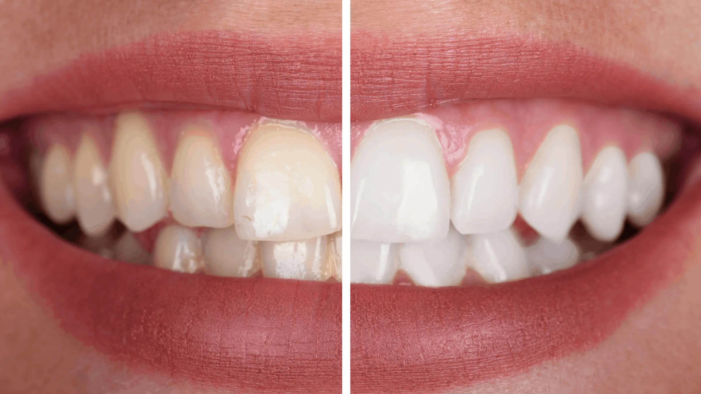 Manchas negras dientes