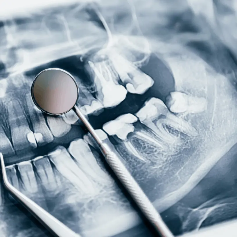 Dientes Debilidados
