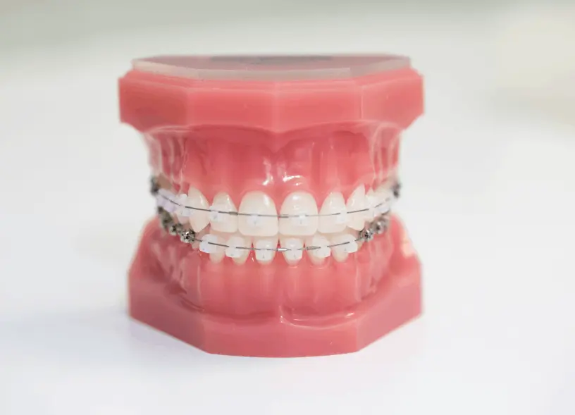 Brackets esteticos