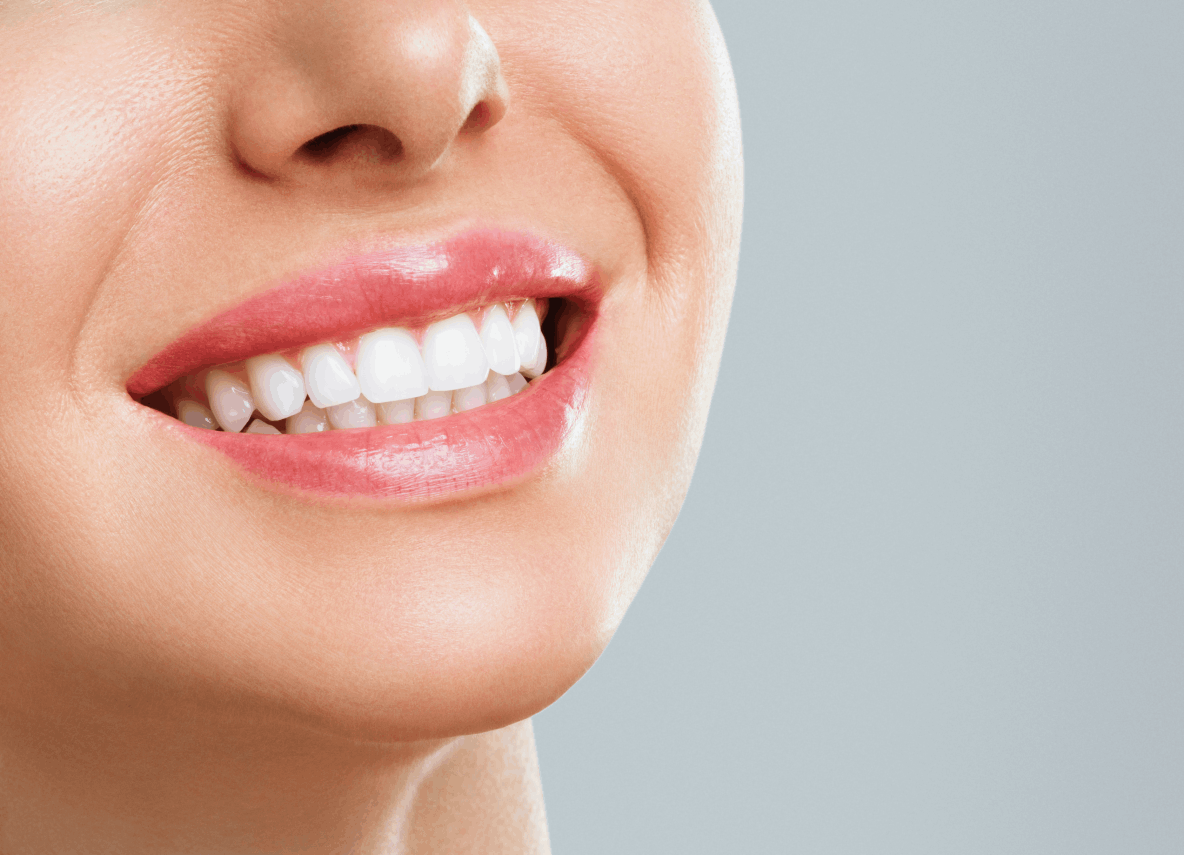 Carillas Dentales