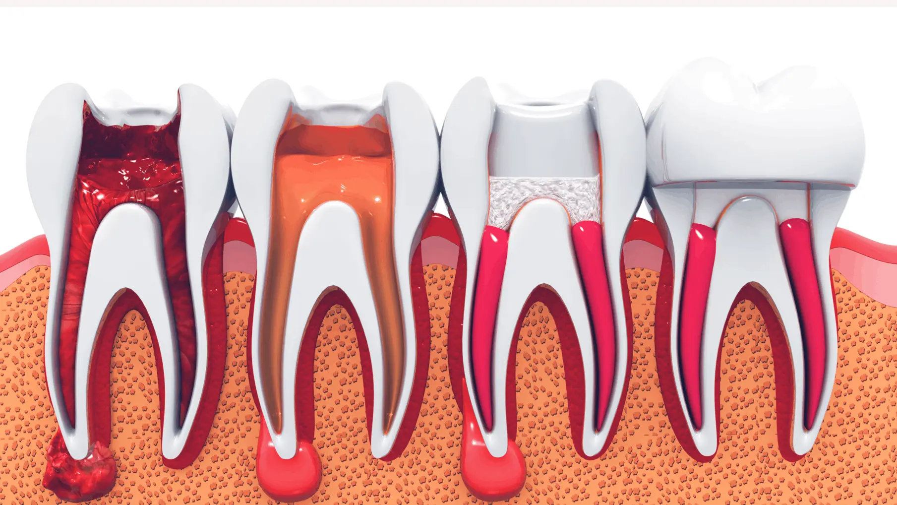 endodoncia