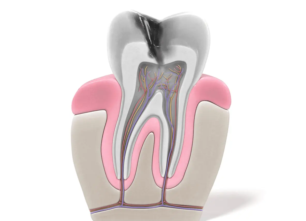 Endodoncia